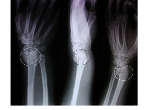 typical Colle's fracture of the wrist - from Wikimedia commons by 
