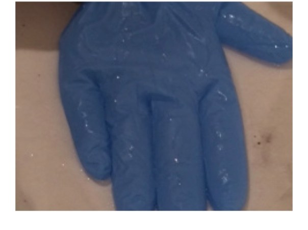 glove about half filled with water - laid flat - notice the thumb is filled with water - this represents cardiac filling pressure