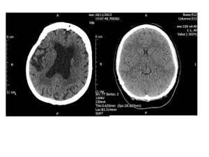 The CT head scan on the left of a healthy 96 year old woman, the one on the right is of a 23 year old woman. The dark portion in the middle of the old brain is fluid, not brain. The younger person's head is completely full of brain.