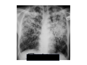 pulmonary TB usually affects the upper part of the lungs