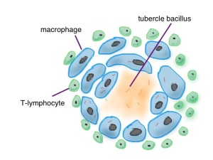 cartoon of a tuberculous granuloma - the centre is caveating - cheese-like - made from dead macrophages