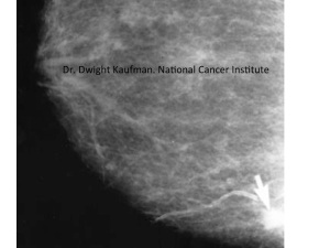 mammogram of breast showing a cancer bottom right