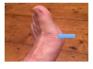 This is the first metatarsophalangeal joint where 50% of first episodes of gout occur